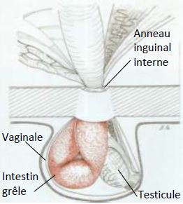 Schéma 2 : hernie inguinale indirecte chez le cheval : l’anse intestinale passe à travers l’anneau vaginal (Gluntz, 2007)